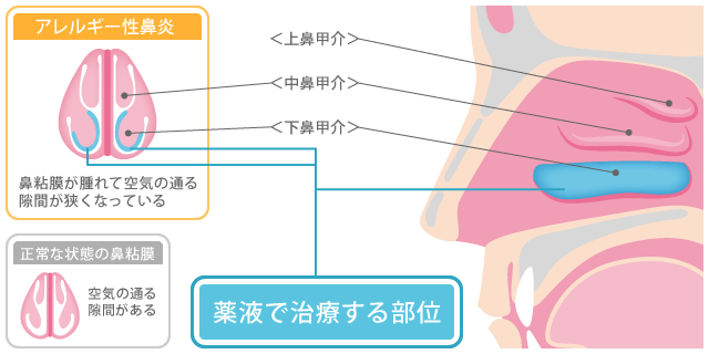 薬液で治療する部位